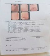 广东民安医院怎么样浅表性胃炎需要治疗吗？