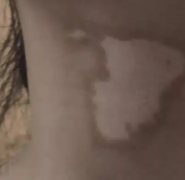 希格玛SQLED308白癜风光疗仪科普：白癜风患者的治疗怎么做？	