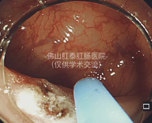 佛山肛泰肛肠医院：肠息肉术后便血，是正常现象还是危险信号？	