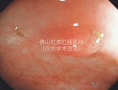 肠息肉怎么防？佛山肛泰肛肠医院：饮食、习惯、筛查三步走