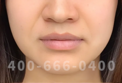 都说手术除皱创伤大，为什么还是那么多人做？八大处整形赵延勇